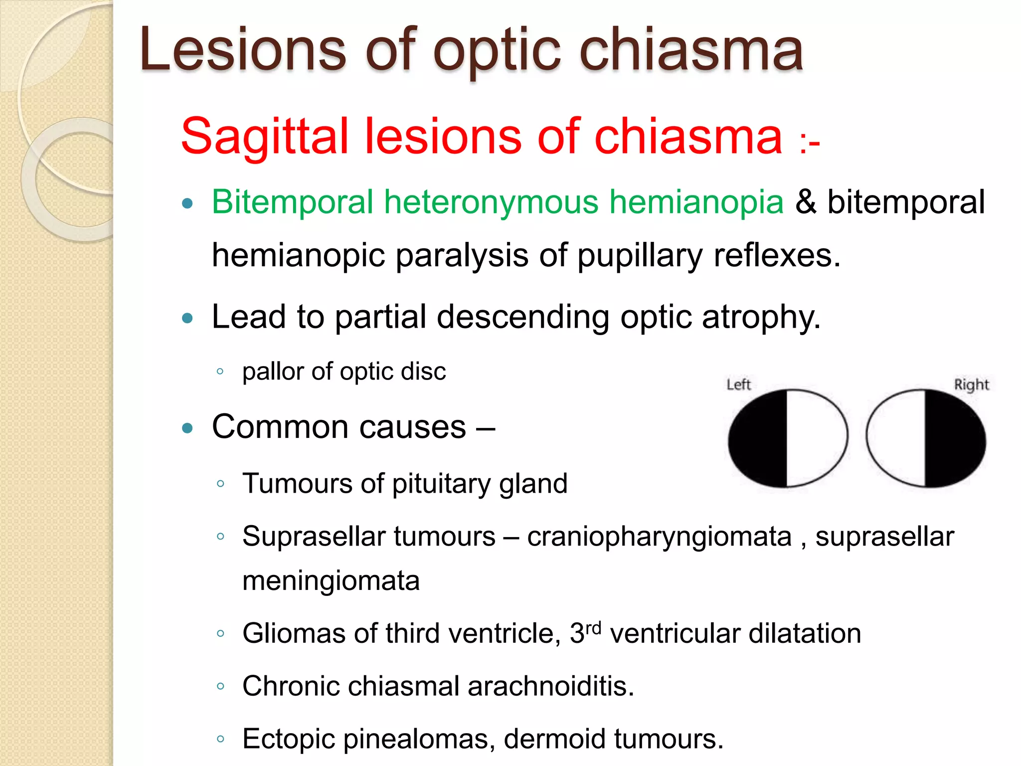 Lesions of optic chiasma
Sagittal lesions of chiasma :-
 Bitemporal heteronymous hemianopia & bitemporal
hemianopic paralysis of pupillary reflexes.
 Lead to partial descending optic atrophy.
◦ pallor of optic disc
 Common causes –
◦ Tumours of pituitary gland
◦ Suprasellar tumours – craniopharyngiomata , suprasellar
meningiomata
◦ Gliomas of third ventricle, 3rd ventricular dilatation
◦ Chronic chiasmal arachnoiditis.
◦ Ectopic pinealomas, dermoid tumours.
 