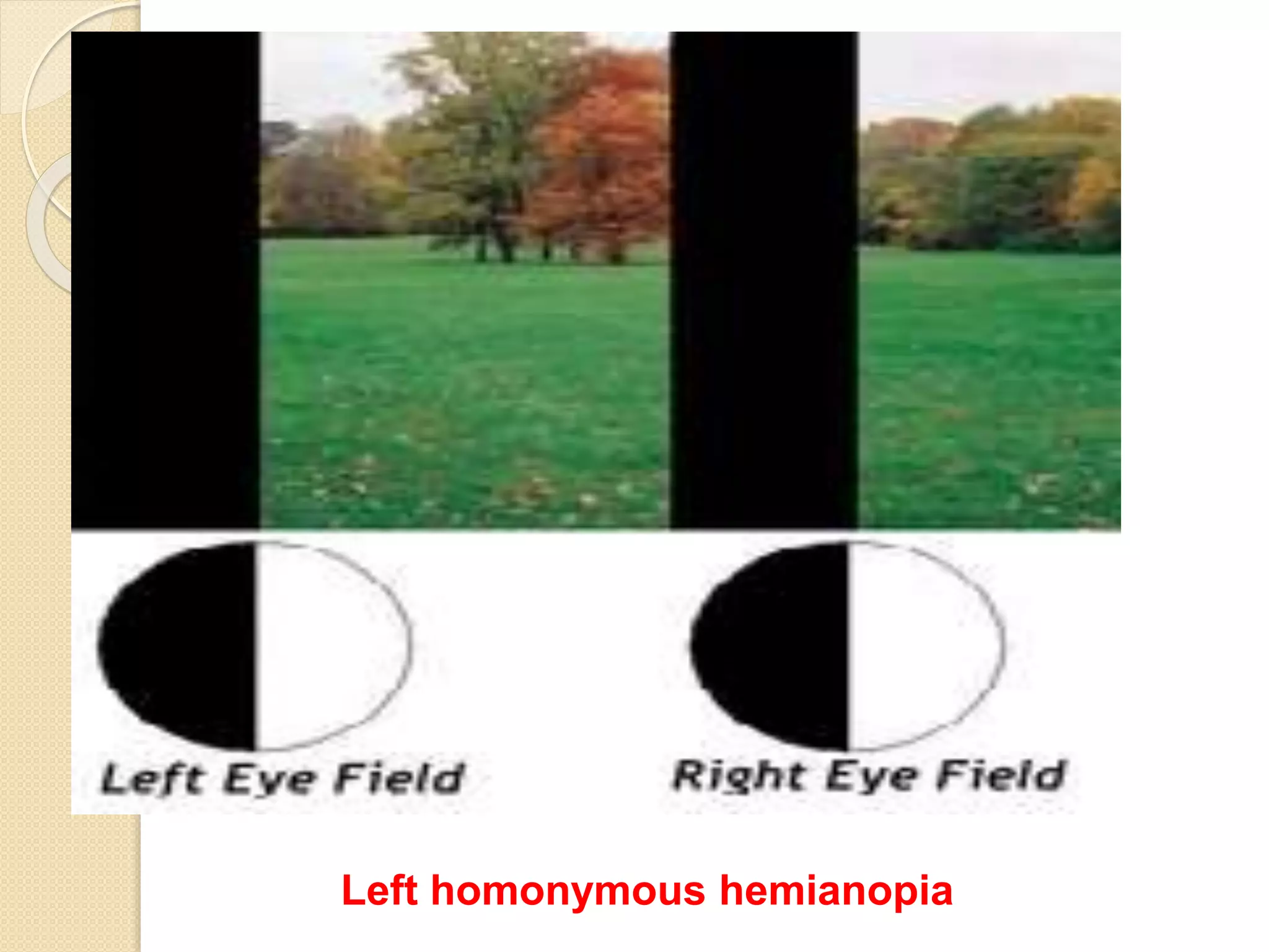 Left homonymous hemianopia
 