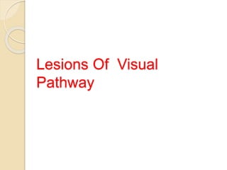 Lesions Of Visual
Pathway
 