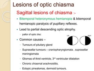 Lesions of optic chiasma
Sagittal lesions of chiasma :-
 Bitemporal heteronymous hemianopia & bitemporal
hemianopic paralysis of pupillary reflexes.
 Lead to partial descending optic atrophy.
◦ pallor of optic disc
 Common causes –
◦ Tumours of pituitary gland
◦ Suprasellar tumours – craniopharyngiomata , suprasellar
meningiomata
◦ Gliomas of third ventricle, 3rd ventricular dilatation
◦ Chronic chiasmal arachnoiditis.
◦ Ectopic pinealomas, dermoid tumours.
 