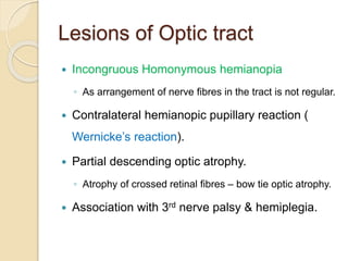 Lesions of Optic tract
 Incongruous Homonymous hemianopia
◦ As arrangement of nerve fibres in the tract is not regular.
 Contralateral hemianopic pupillary reaction (
Wernicke’s reaction).
 Partial descending optic atrophy.
◦ Atrophy of crossed retinal fibres – bow tie optic atrophy.
 Association with 3rd nerve palsy & hemiplegia.
 