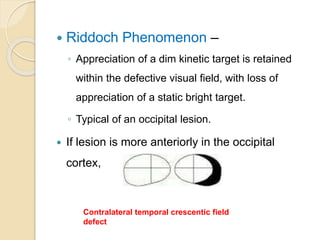  Riddoch Phenomenon –
◦ Appreciation of a dim kinetic target is retained
within the defective visual field, with loss of
appreciation of a static bright target.
◦ Typical of an occipital lesion.
 If lesion is more anteriorly in the occipital
cortex,
Contralateral temporal crescentic field
defect
 