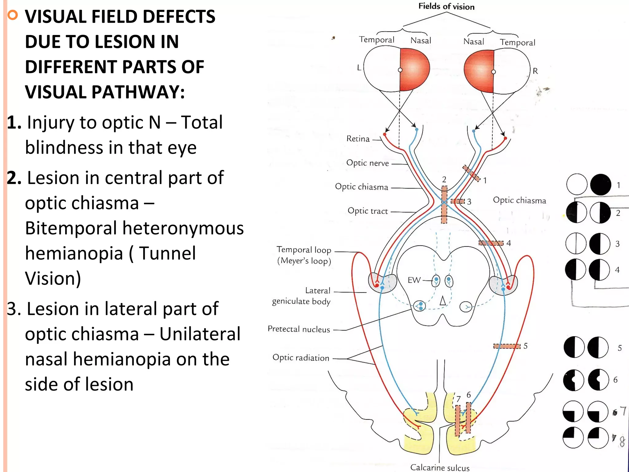  VISUAL FIELD DEFECTS
DUE TO LESION IN
DIFFERENT PARTS OF
VISUAL PATHWAY:
1. Injury to optic N – Total
blindness in that eye
2. Lesion in central part of
optic chiasma –
Bitemporal heteronymous
hemianopia ( Tunnel
Vision)
3. Lesion in lateral part of
optic chiasma – Unilateral
nasal hemianopia on the
side of lesion
 
