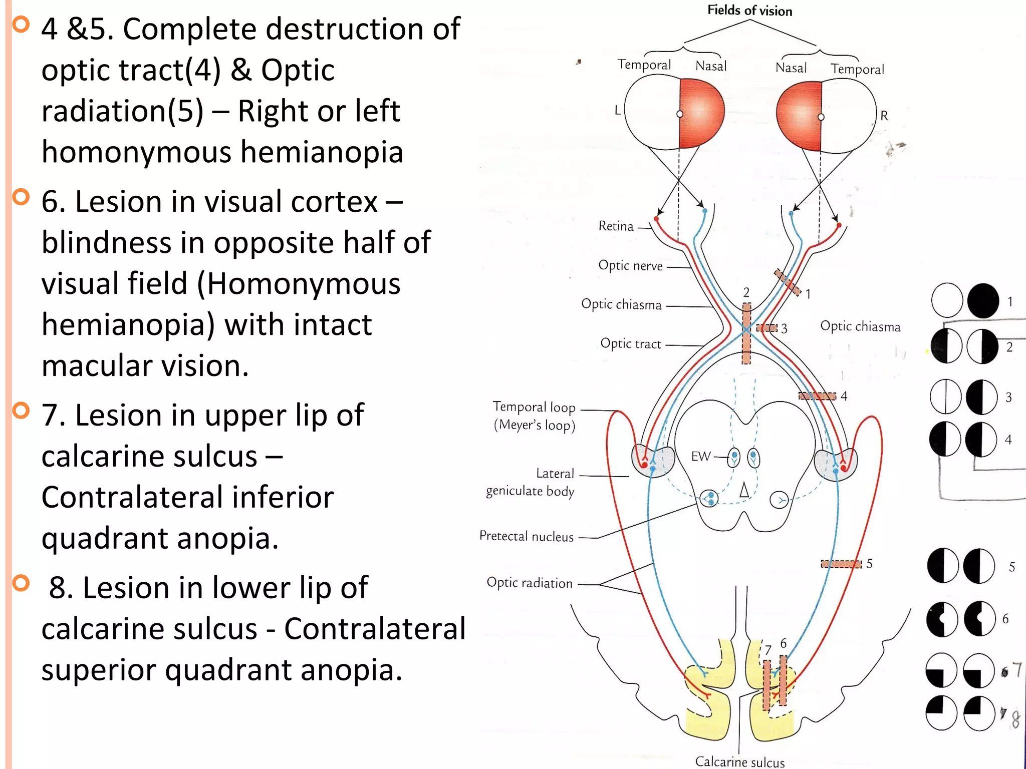  4 &5. Complete destruction of
optic tract(4) & Optic
radiation(5) – Right or left
homonymous hemianopia
 6. Lesion in visual cortex –
blindness in opposite half of
visual field (Homonymous
hemianopia) with intact
macular vision.
 7. Lesion in upper lip of
calcarine sulcus –
Contralateral inferior
quadrant anopia.
 8. Lesion in lower lip of
calcarine sulcus - Contralateral
superior quadrant anopia.
 