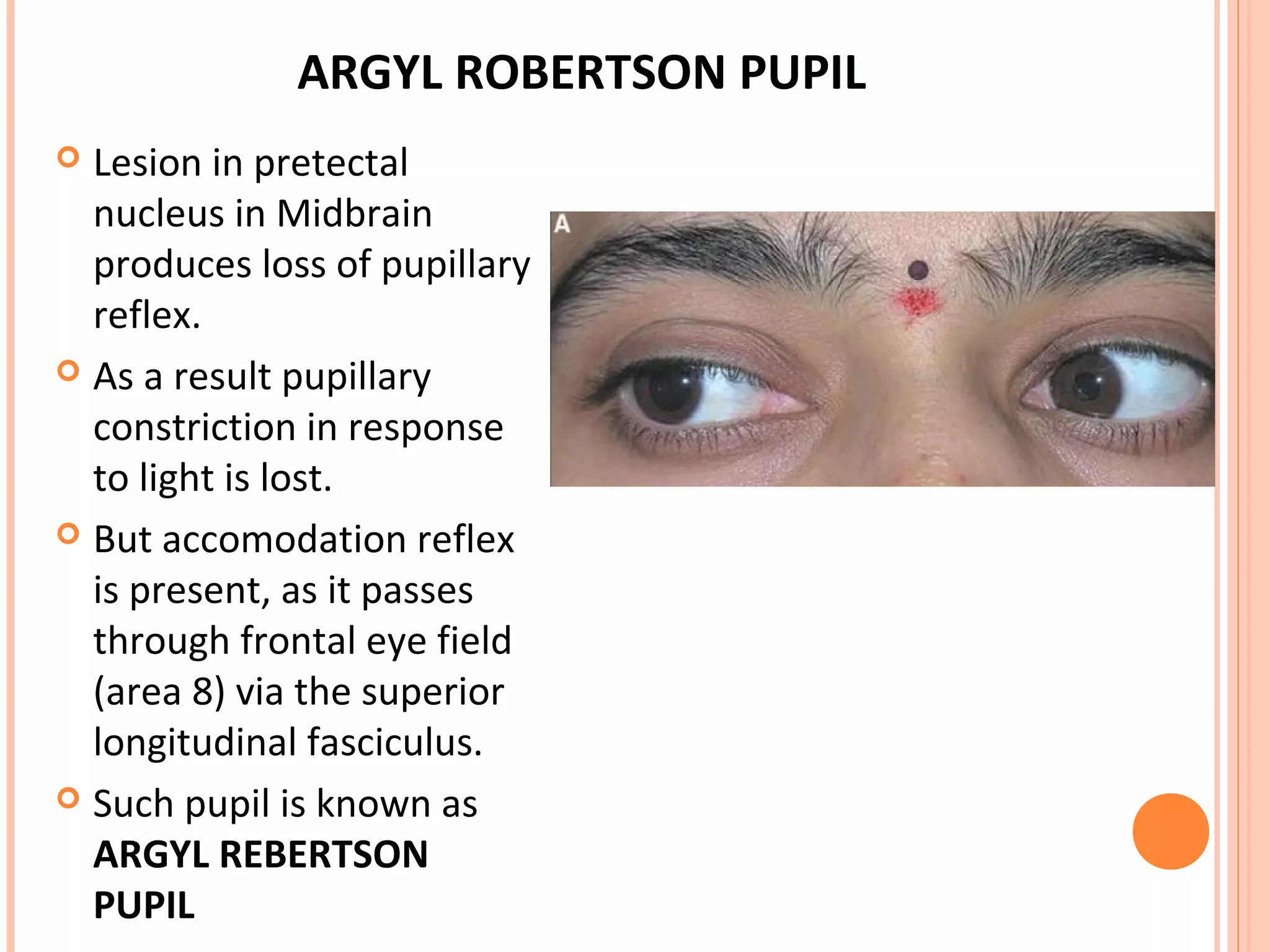 ARGYL ROBERTSON PUPIL
 Lesion in pretectal
nucleus in Midbrain
produces loss of pupillary
reflex.
 As a result pupillary
constriction in response
to light is lost.
 But accomodation reflex
is present, as it passes
through frontal eye field
(area 8) via the superior
longitudinal fasciculus.
 Such pupil is known as
ARGYL REBERTSON
PUPIL
 