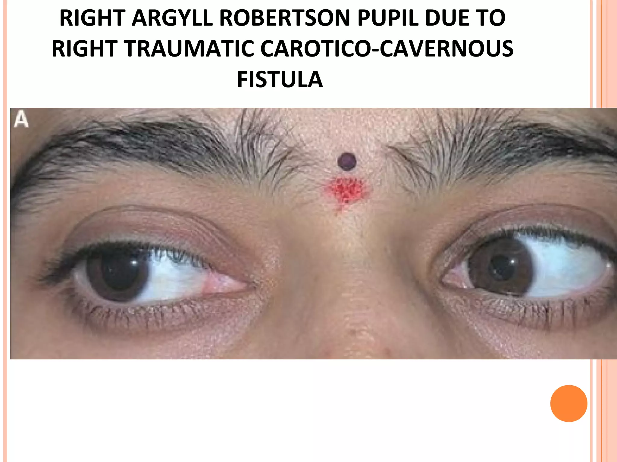 RIGHT ARGYLL ROBERTSON PUPIL DUE TO
RIGHT TRAUMATIC CAROTICO-CAVERNOUS
FISTULA
 