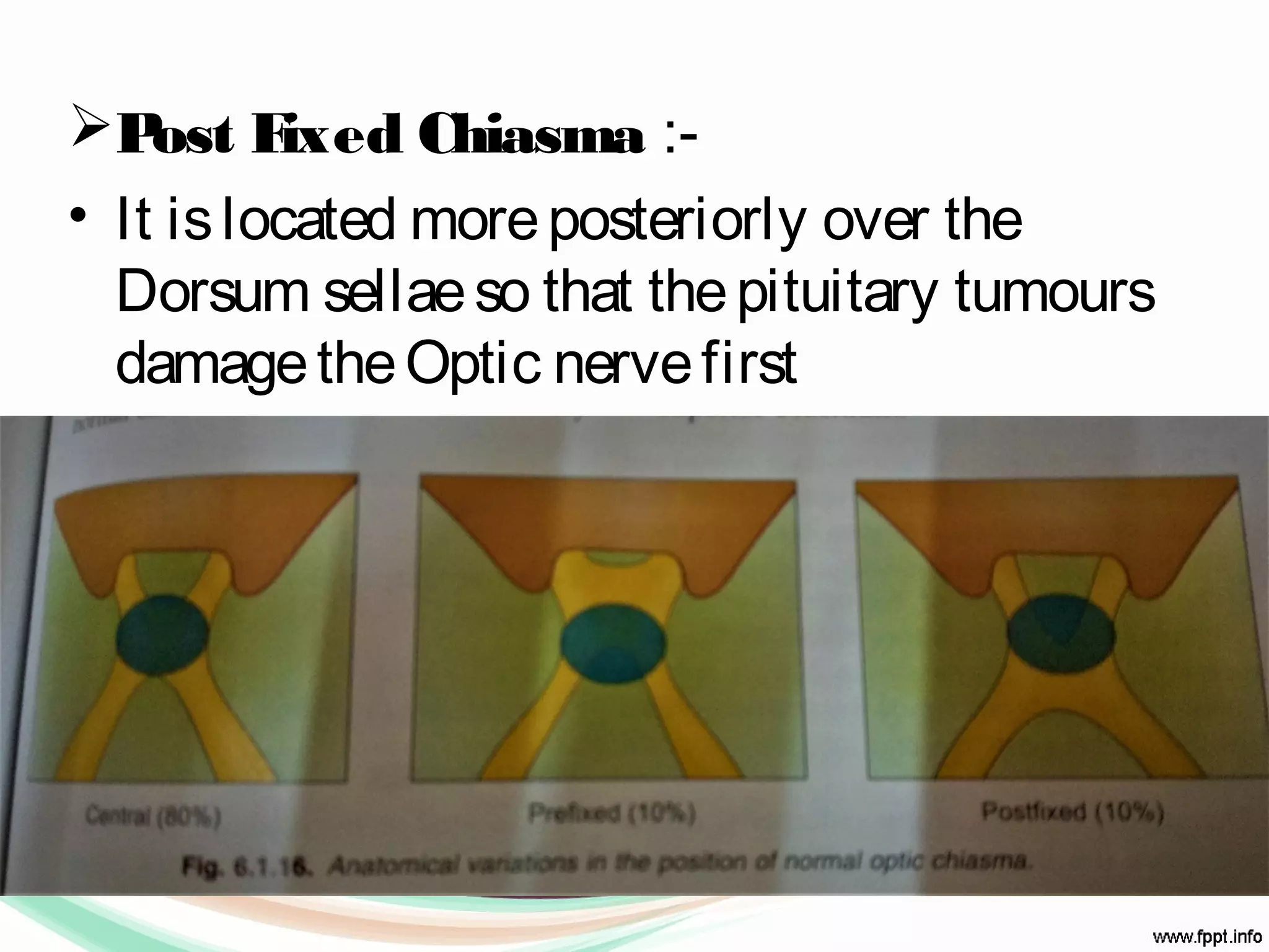 Post Fixed Chiasma :-
• It islocated moreposteriorly over the
Dorsum sellaeso that thepituitary tumours
damagetheOptic nervefirst
 