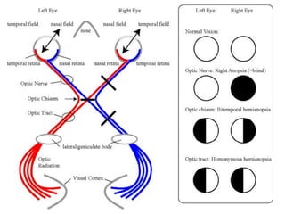 Visual pathway ,visual cortex and hemianopias | PPTX
