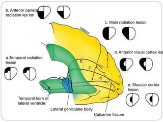 b. Anterior parietal
radiation les ion
a.Temporal radiation
lesion
c. Main radiation lesion
d. Anterior visual cortex les
e. Macular cortex
lesion
Temporal horn of
lateral ventricle
Lateral geniculate body
Calcarine fissure
a
b
c
d
e
 