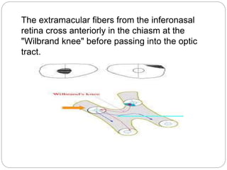 The extramacular fibers from the inferonasal
retina cross anteriorly in the chiasm at the
"Wilbrand knee" before passing into the optic
tract.
 