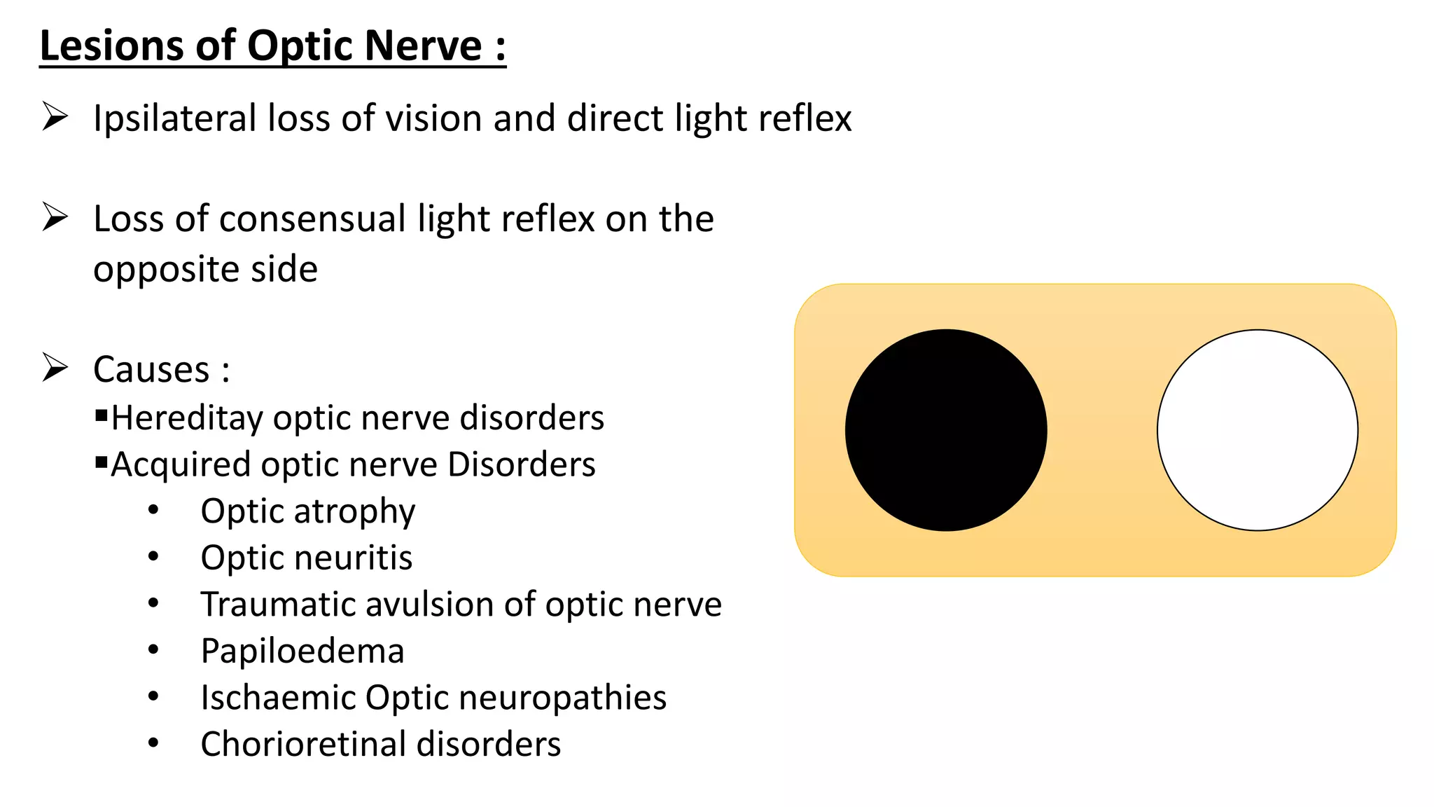 Lesions of Optic Nerve :
 Ipsilateral loss of vision and direct light reflex
 Loss of consensual light reflex on the
opposite side
 Causes :
Hereditay optic nerve disorders
Acquired optic nerve Disorders
• Optic atrophy
• Optic neuritis
• Traumatic avulsion of optic nerve
• Papiloedema
• Ischaemic Optic neuropathies
• Chorioretinal disorders
 