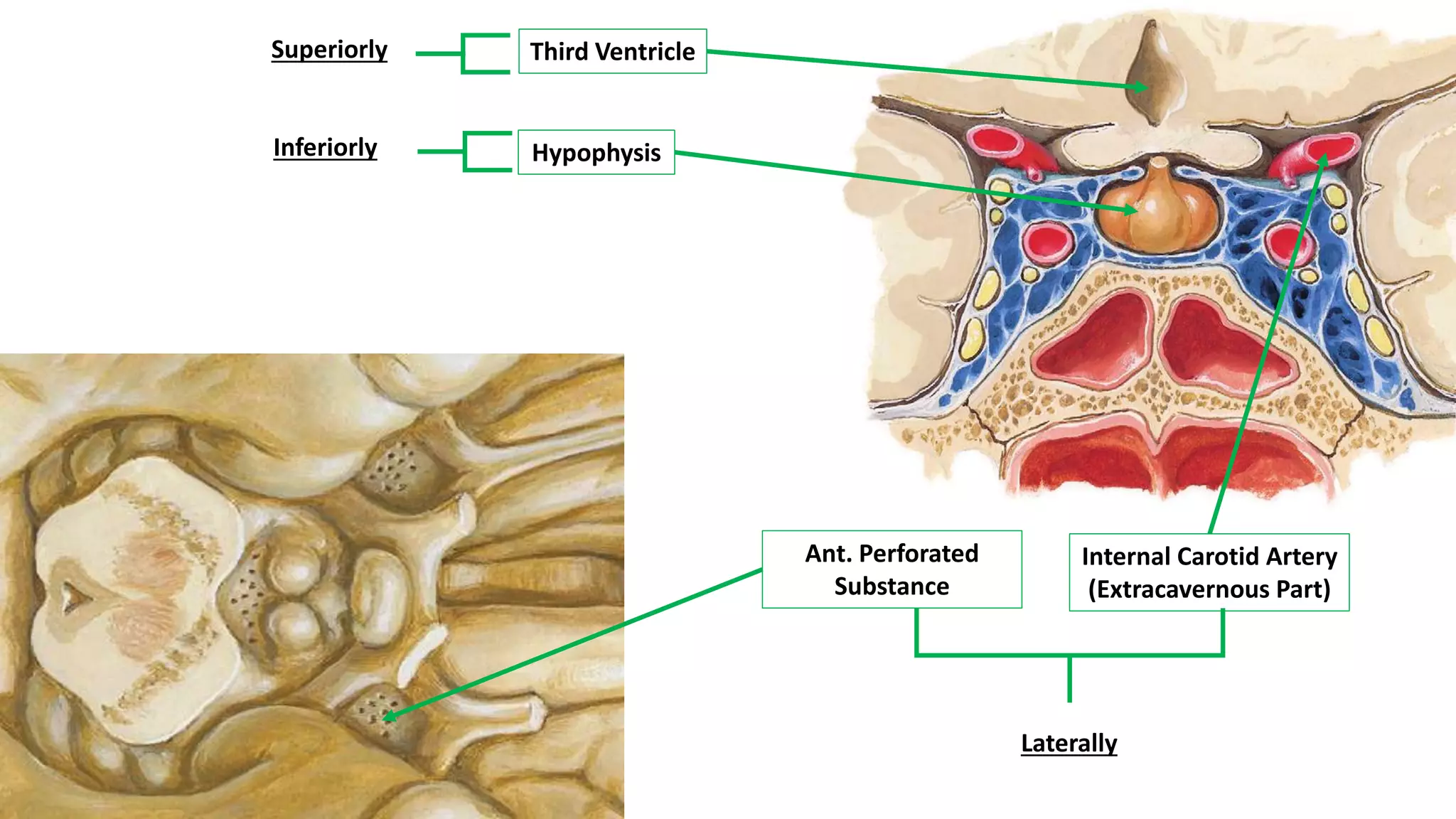 Laterally
Third Ventricle
Hypophysis
Ant. Perforated
Substance
Internal Carotid Artery
(Extracavernous Part)
Superiorly
Inferiorly
 