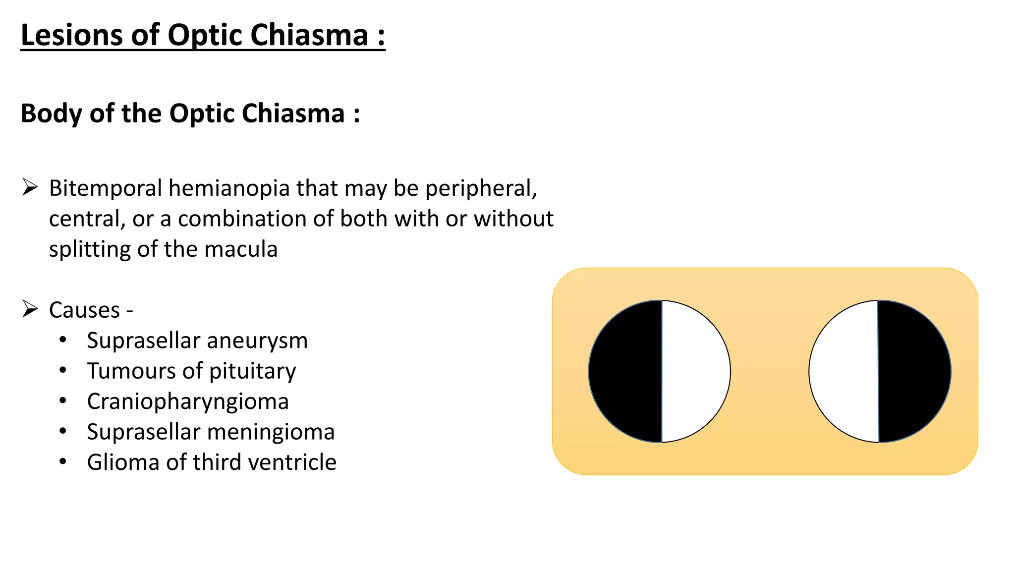 Lesions of Optic Chiasma :
 Bitemporal hemianopia that may be peripheral,
central, or a combination of both with or without
splitting of the macula
 Causes -
• Suprasellar aneurysm
• Tumours of pituitary
• Craniopharyngioma
• Suprasellar meningioma
• Glioma of third ventricle
Body of the Optic Chiasma :
 