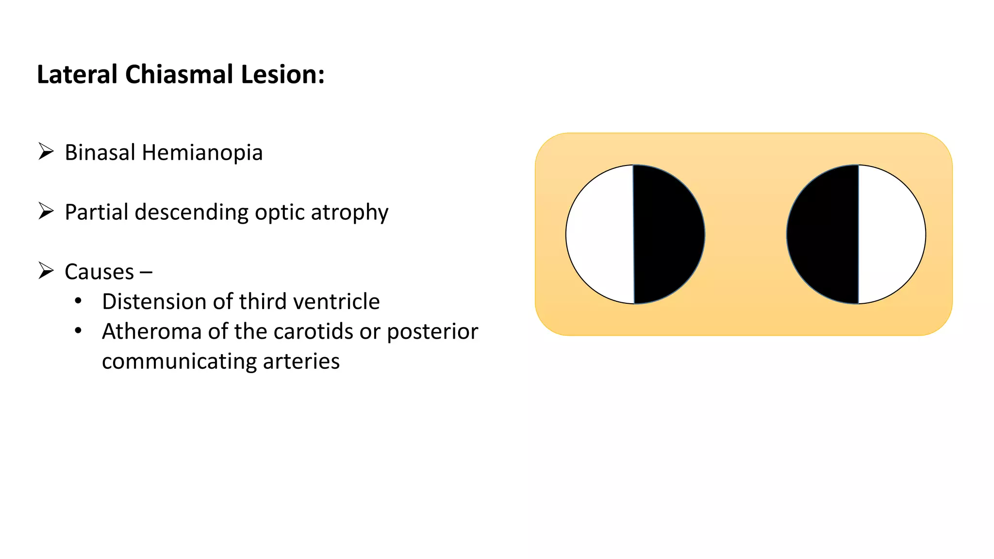  Binasal Hemianopia
 Partial descending optic atrophy
 Causes –
• Distension of third ventricle
• Atheroma of the carotids or posterior
communicating arteries
Lateral Chiasmal Lesion:
 
