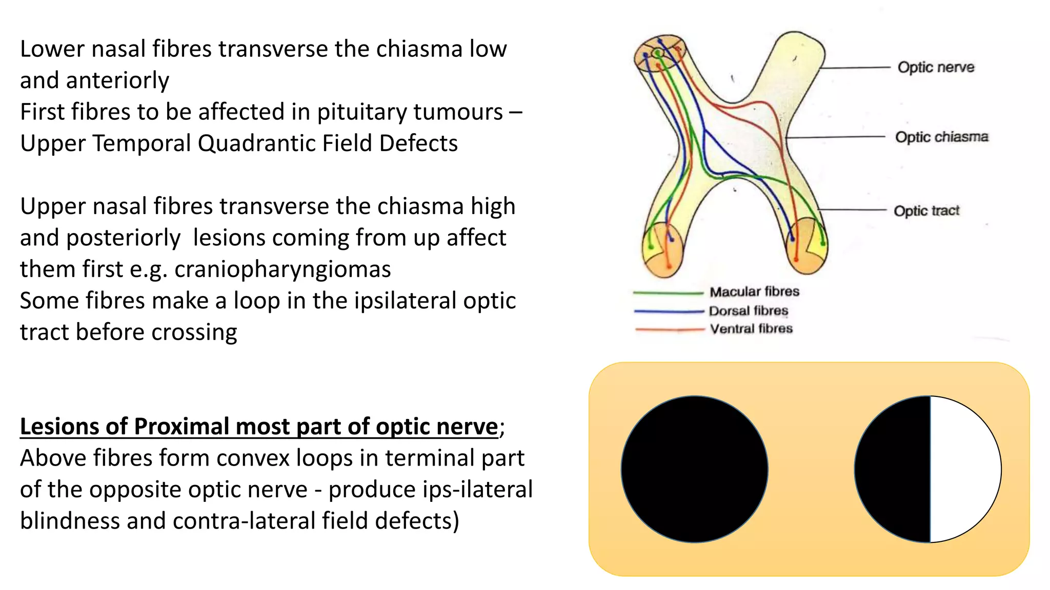 Lower nasal fibres transverse the chiasma low
and anteriorly
First fibres to be affected in pituitary tumours –
Upper Temporal Quadrantic Field Defects
Upper nasal fibres transverse the chiasma high
and posteriorly lesions coming from up affect
them first e.g. craniopharyngiomas
Some fibres make a loop in the ipsilateral optic
tract before crossing
Lesions of Proximal most part of optic nerve;
Above fibres form convex loops in terminal part
of the opposite optic nerve - produce ips-ilateral
blindness and contra-lateral field defects)
 