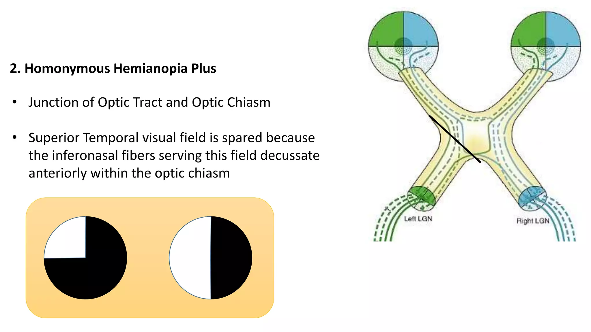 2. Homonymous Hemianopia Plus
• Junction of Optic Tract and Optic Chiasm
• Superior Temporal visual field is spared because
the inferonasal fibers serving this field decussate
anteriorly within the optic chiasm
 