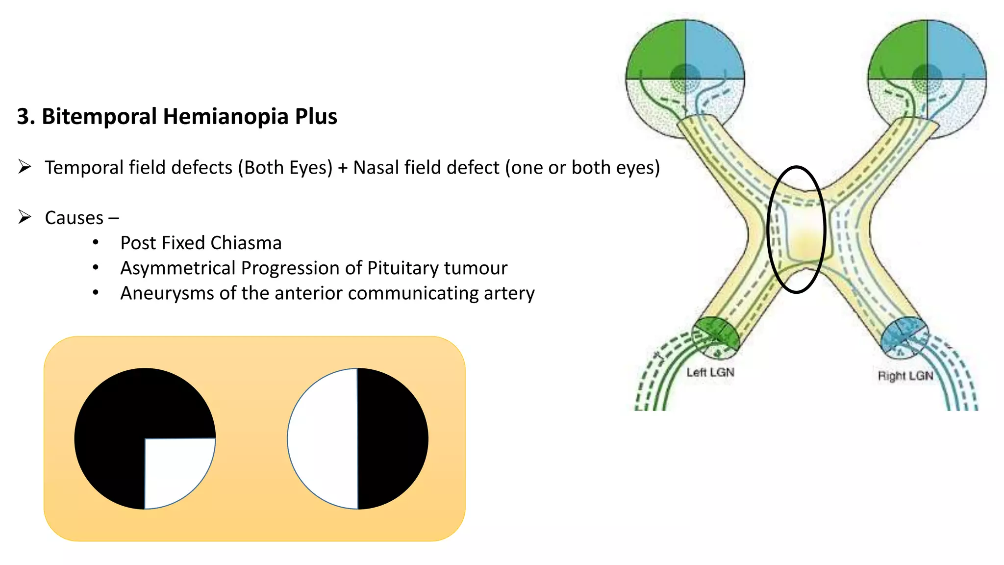 3. Bitemporal Hemianopia Plus
 Temporal field defects (Both Eyes) + Nasal field defect (one or both eyes)
 Causes –
• Post Fixed Chiasma
• Asymmetrical Progression of Pituitary tumour
• Aneurysms of the anterior communicating artery
 