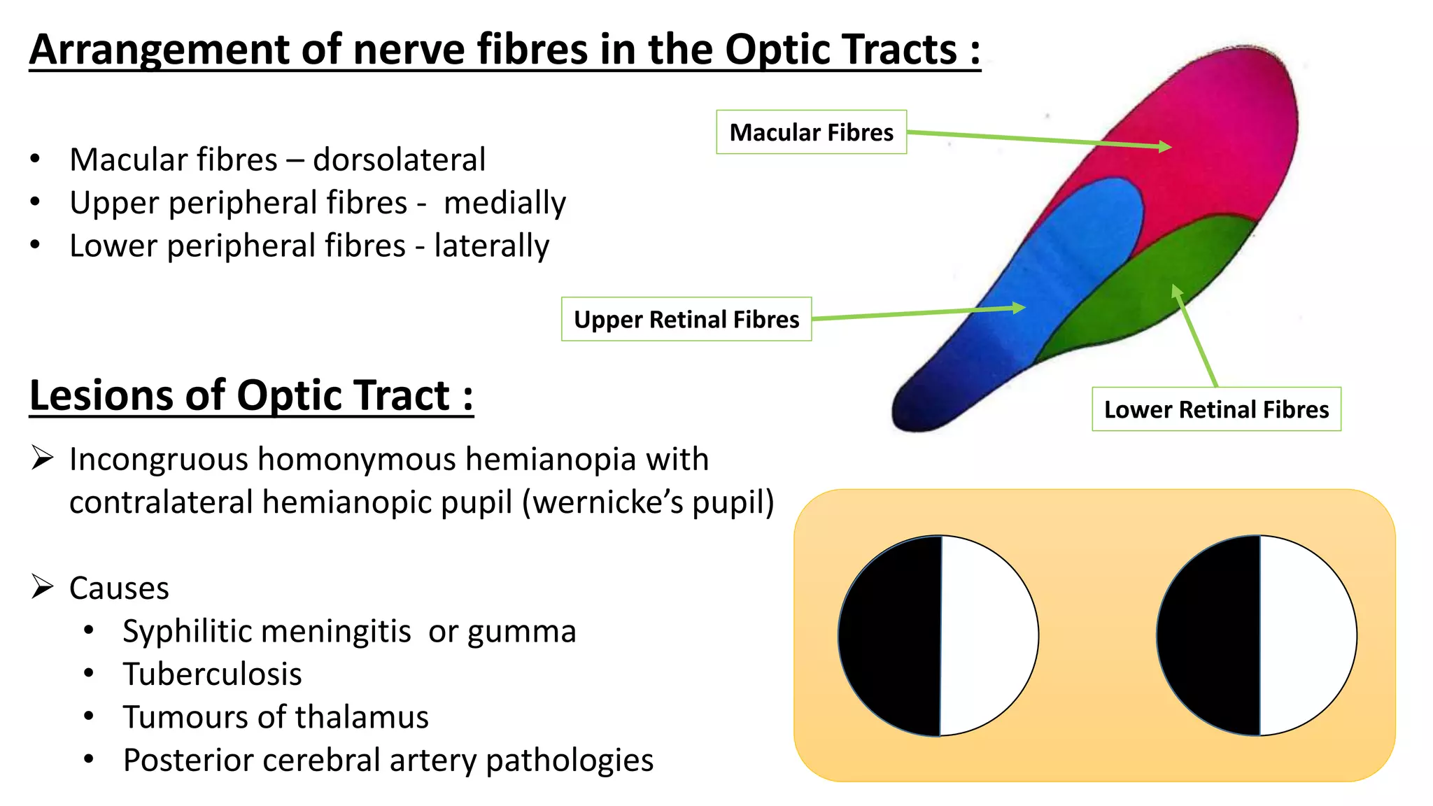 Arrangement of nerve fibres in the Optic Tracts :
• Macular fibres – dorsolateral
• Upper peripheral fibres - medially
• Lower peripheral fibres - laterally
 Incongruous homonymous hemianopia with
contralateral hemianopic pupil (wernicke’s pupil)
 Causes
• Syphilitic meningitis or gumma
• Tuberculosis
• Tumours of thalamus
• Posterior cerebral artery pathologies
Lesions of Optic Tract :
Upper Retinal Fibres
Macular Fibres
Lower Retinal Fibres
 