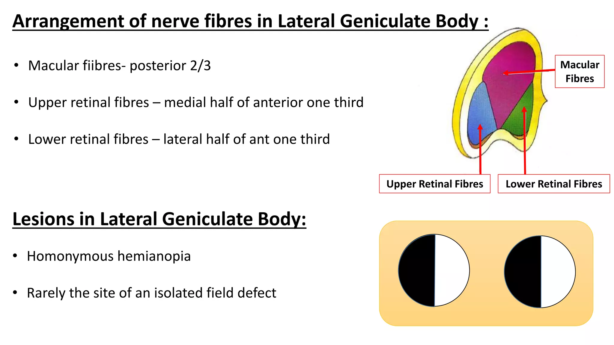 Arrangement of nerve fibres in Lateral Geniculate Body :
Upper Retinal Fibres
Macular
Fibres
Lower Retinal Fibres
• Macular fiibres- posterior 2/3
• Upper retinal fibres – medial half of anterior one third
• Lower retinal fibres – lateral half of ant one third
• Homonymous hemianopia
• Rarely the site of an isolated field defect
Lesions in Lateral Geniculate Body:
 