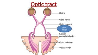 Optic tract
OPTIC
TRACT
 