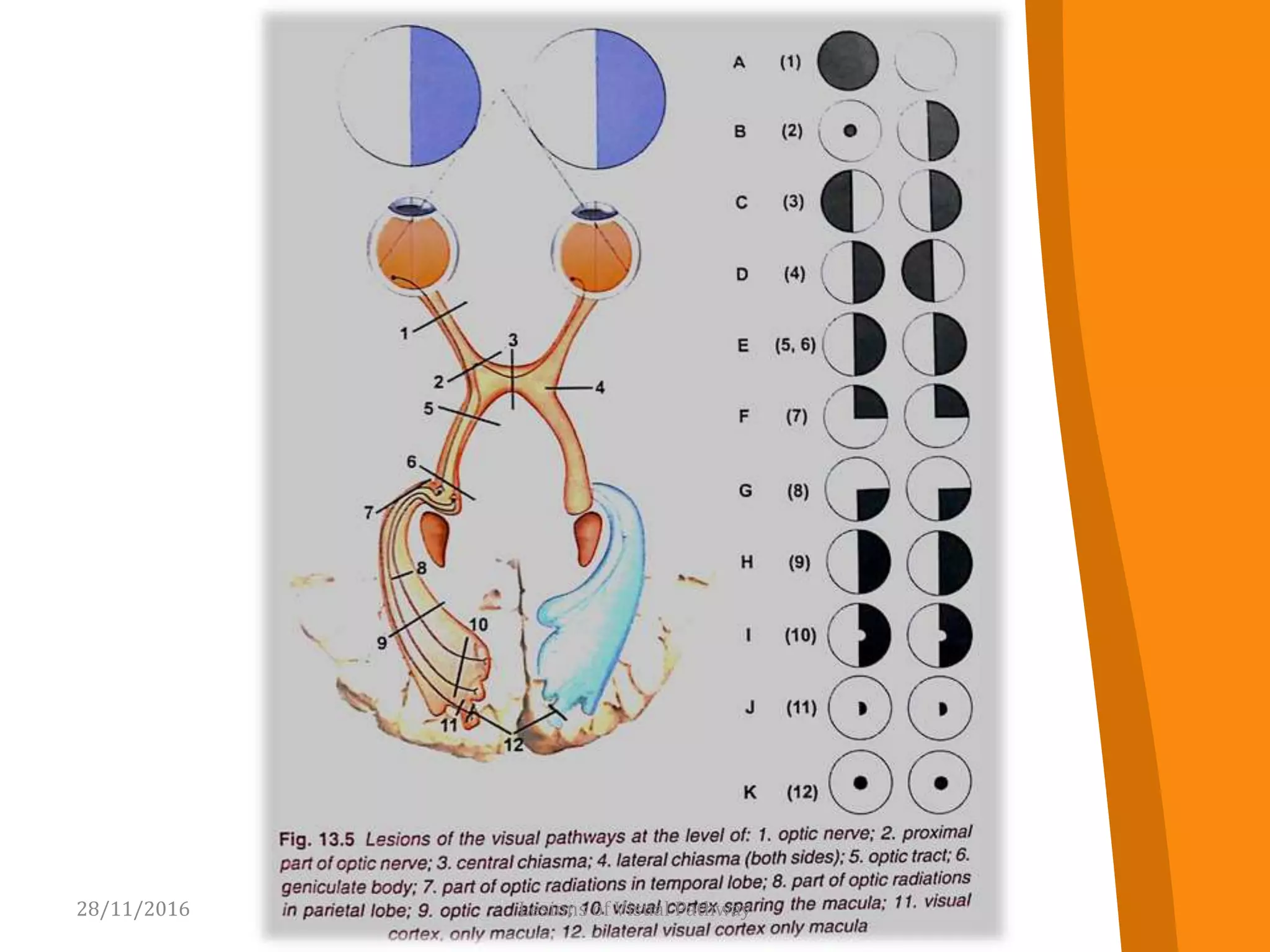 28/11/2016 17Lesions of Visual Pathway
 