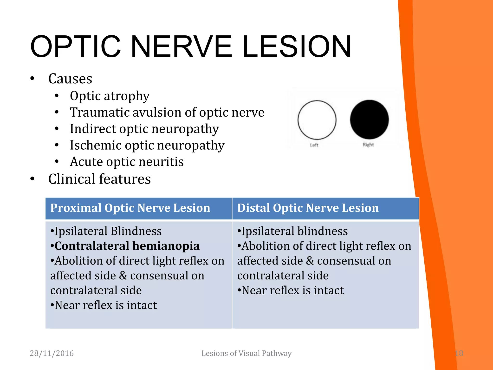 OPTIC NERVE LESION
• Causes
• Optic atrophy
• Traumatic avulsion of optic nerve
• Indirect optic neuropathy
• Ischemic optic neuropathy
• Acute optic neuritis
• Clinical features
28/11/2016 18
Proximal Optic Nerve Lesion Distal Optic Nerve Lesion
•Ipsilateral Blindness
•Contralateral hemianopia
•Abolition of direct light reflex on
affected side & consensual on
contralateral side
•Near reflex is intact
•Ipsilateral blindness
•Abolition of direct light reflex on
affected side & consensual on
contralateral side
•Near reflex is intact
Lesions of Visual Pathway
 