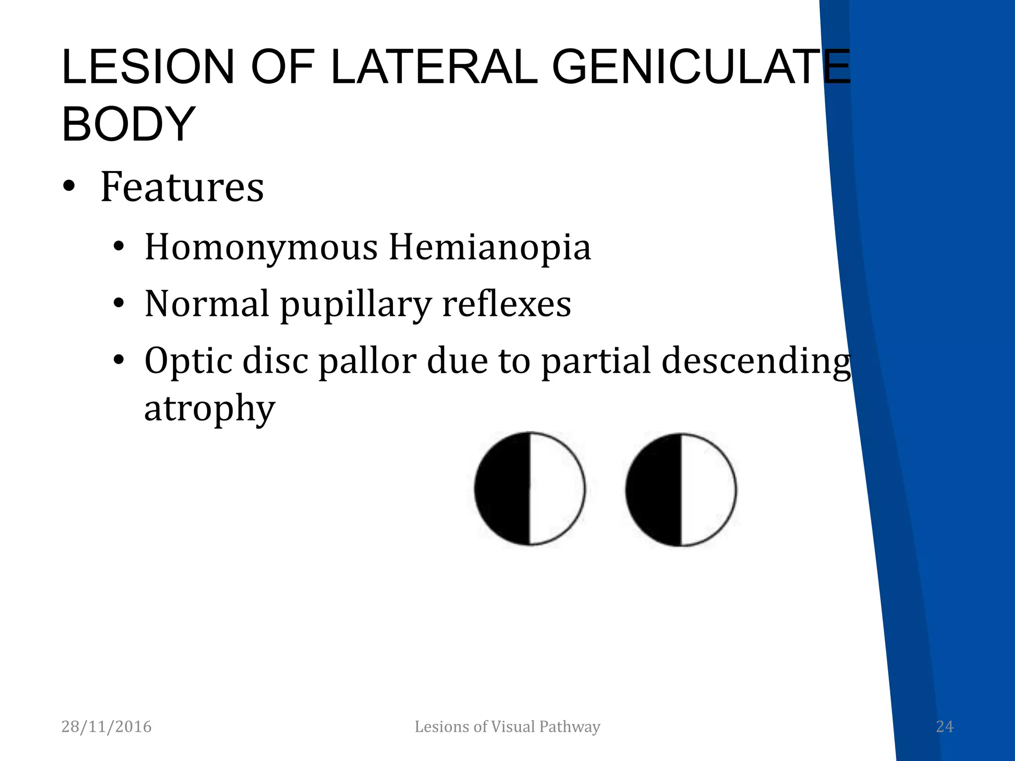 LESION OF LATERAL GENICULATE
BODY
• Features
• Homonymous Hemianopia
• Normal pupillary reflexes
• Optic disc pallor due to partial descending
atrophy
28/11/2016 24Lesions of Visual Pathway
 