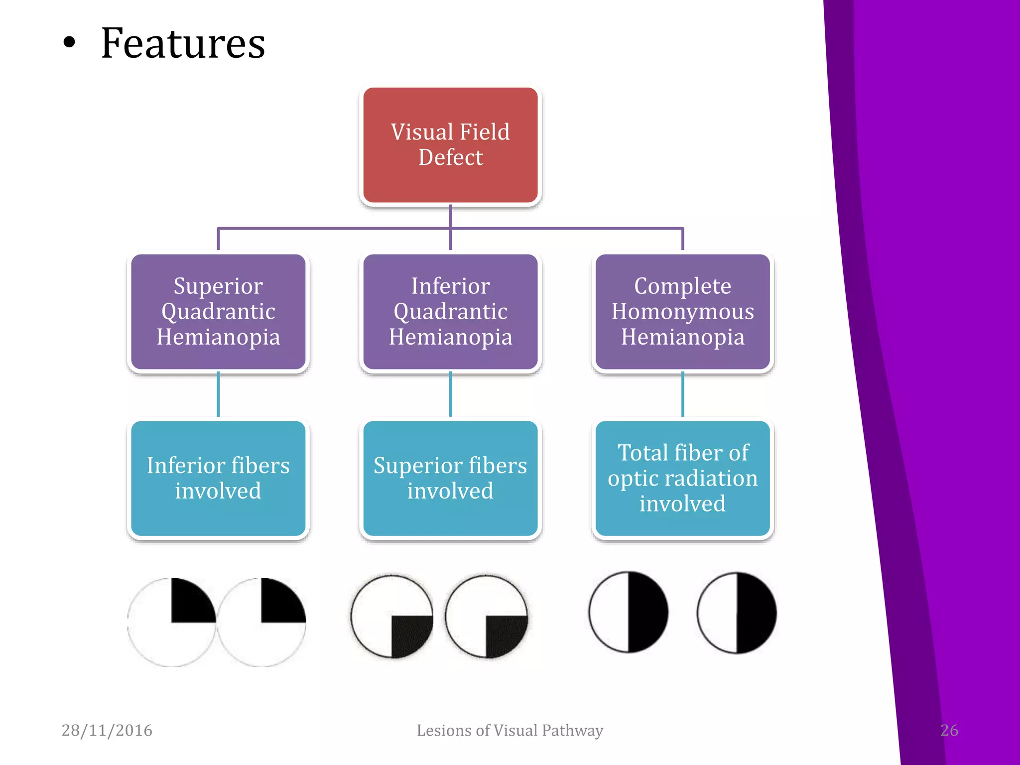• Features
Visual Field
Defect
Superior
Quadrantic
Hemianopia
Inferior fibers
involved
Inferior
Quadrantic
Hemianopia
Superior fibers
involved
Complete
Homonymous
Hemianopia
Total fiber of
optic radiation
involved
28/11/2016 26Lesions of Visual Pathway
 