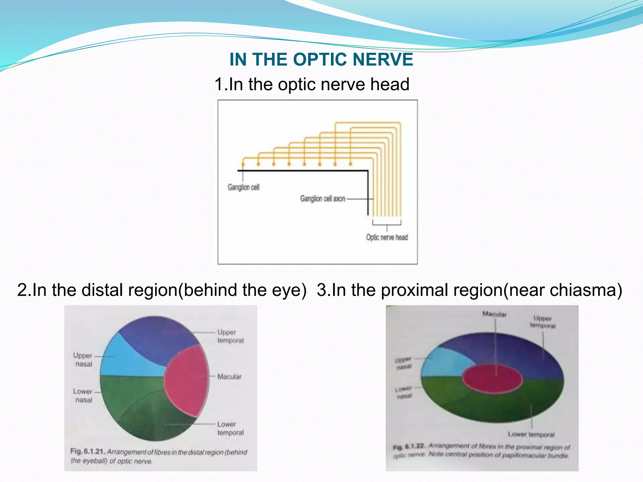 IN THE OPTIC NERVE
1.In the optic nerve head
2.In the distal region(behind the eye) 3.In the proximal region(near chiasma)
 