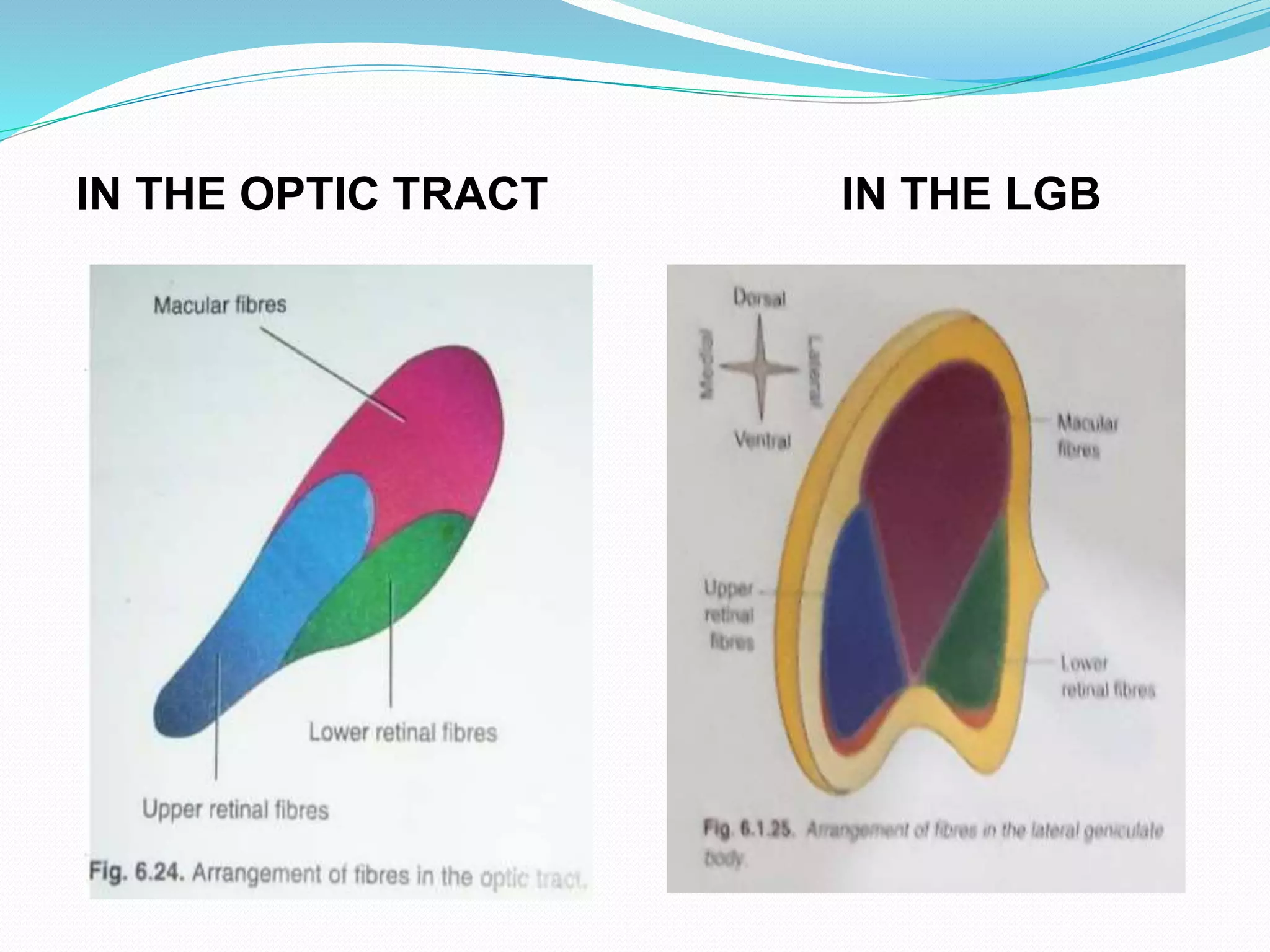 IN THE OPTIC TRACT IN THE LGB
 