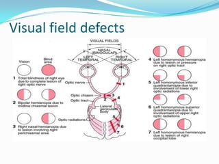 Visual field defects

 