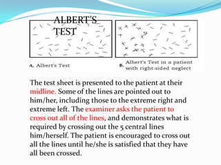 ALBERT’S
TEST

The test sheet is presented to the patient at their
midline. Some of the lines are pointed out to
him/her, including those to the extreme right and
extreme left. The examiner asks the patient to
cross out all of the lines, and demonstrates what is
required by crossing out the 5 central lines
him/herself. The patient is encouraged to cross out
all the lines until he/she is satisfied that they have
all been crossed.

 