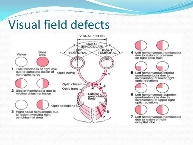 Visual Field Defects Chart