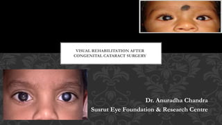 Dr. Anuradha Chandra
Susrut Eye Foundation & Research Centre
VISUAL REHABILITATION AFTER
CONGENITAL CATARACT SURGERY
 