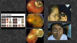 Visual rehabilitation after pediatric cataract surgery 