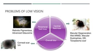 Central
field loss
Overall blur
Peripheral
field loss
Macular Degeneration
Wet ARMD, Macular
Dystrophies, DR,
Toxoplasma scar
Retinitis Pigmentosa,
Advanced Glaucoma
Corneal scar ,
VH
PROBLEMS OF LOW VISION
 