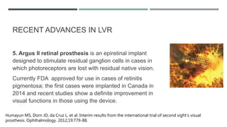 RECENT ADVANCES IN LVR
5. Argus II retinal prosthesis is an epiretinal implant
designed to stimulate residual ganglion cells in cases in
which photoreceptors are lost with residual native vision.
Currently FDA approved for use in cases of retinitis
pigmentosa; the first cases were implanted in Canada in
2014 and recent studies show a definite improvement in
visual functions in those using the device.
Humayun MS, Dorn JD, da Cruz L, et al. Interim results from the international trial of second sight’s visual
prosthesis. Ophthalmology. 2012;19:779-88.
 