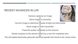Camera captures an image
Send image to microchip
Convert image to electrical impulse of light and dark pixels
Send image to radio transmitter
Transmits pulses wirelessly to the receiver
Sends impulses to the retinal implant by a hair thin implanted wire
The stimulated electrodes generate electrical signals that travel to the visual cortex
RECENT ADVANCES IN LVR
 
