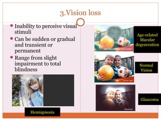 3.Vision loss
Inability to perceive visual
stimuli
Can be sudden or gradual
and transient or
permanent
Range from sligh...