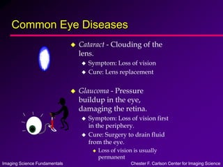 Imaging Science Fundamentals Chester F. Carlson Center for Imaging Science
Common Eye Diseases
 Cataract - Clouding of the
lens.
 Symptom: Loss of vision
 Cure: Lens replacement
 Glaucoma - Pressure
buildup in the eye,
damaging the retina.
 Symptom: Loss of vision first
in the periphery.
 Cure: Surgery to drain fluid
from the eye.
 Loss of vision is usually
permanent
 