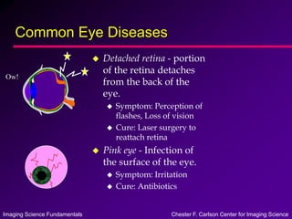 Imaging Science Fundamentals Chester F. Carlson Center for Imaging Science
Common Eye Diseases
 Detached retina - portion
of the retina detaches
from the back of the
eye.
 Symptom: Perception of
flashes, Loss of vision
 Cure: Laser surgery to
reattach retina
 Pink eye - Infection of
the surface of the eye.
 Symptom: Irritation
 Cure: Antibiotics
Ow!
 