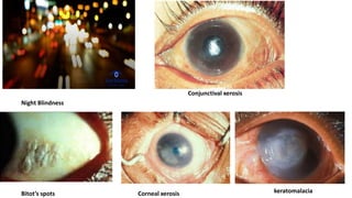 Night Blindness
Conjunctival xerosis
Bitot’s spots Corneal xerosis keratomalacia
 