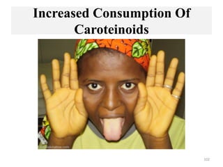 Increased Consumption Of
Caroteinoids
102
 