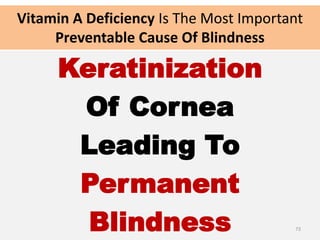 Vitamin A Deficiency Is The Most Important
Preventable Cause Of Blindness
Keratinization
Of Cornea
Leading To
Permanent
Blindness 73
 
