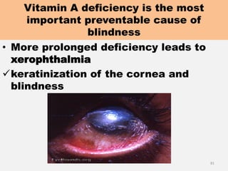 Vitamin A deficiency is the most
important preventable cause of
blindness
• More prolonged deficiency leads to
xerophthalmia
keratinization of the cornea and
blindness
81
 