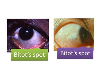 Bitot’s spot Bitot’s spot
 