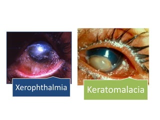 KeratomalaciaXerophthalmia
 