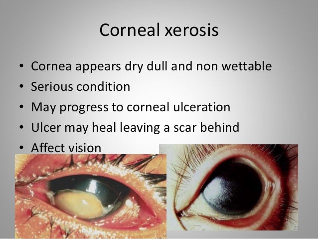 Conjunctival Xerosis Meaning