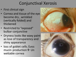 Vit A and vit a deficiencydisorders.pptx
