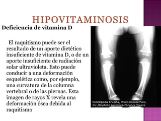 Deficiencia de vitamina D
El raquitismo puede ser el
resultado de un aporte dietético
insuficiente de vitamina D, o de un
aporte insuficiente de radiación
solar ultravioleta. Esto puede
conducir a una deformación
esquelética como, por ejemplo,
una curvatura de la columna
vertebral o de las piernas. Esta
imagen de rayos X revela una
deformación ósea debida al
raquitismo

 